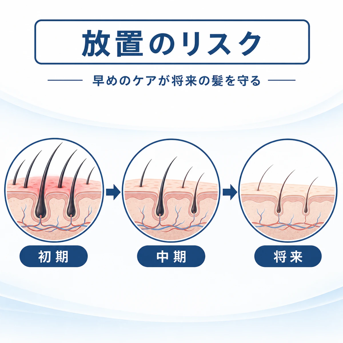 頭皮ニキビの放置が毛包の縮小や髪の細りへ段階的に進むリスクを表した医療イラスト