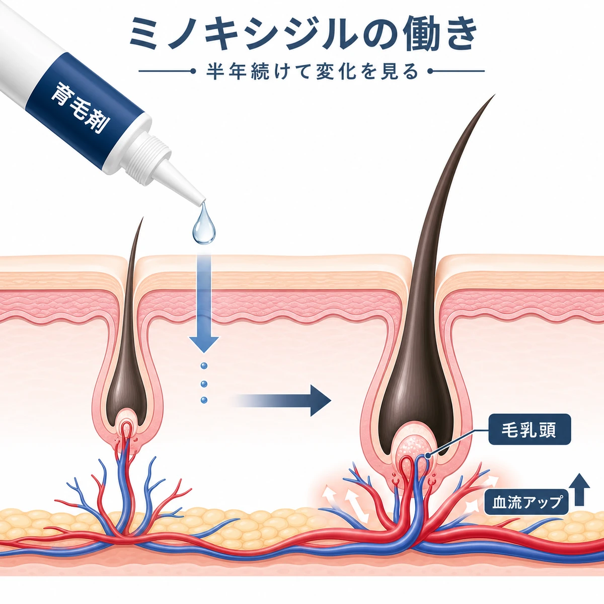 ミノキシジル外用薬が頭皮に浸透し血流を促して毛を育てる仕組みを表した医療イラスト