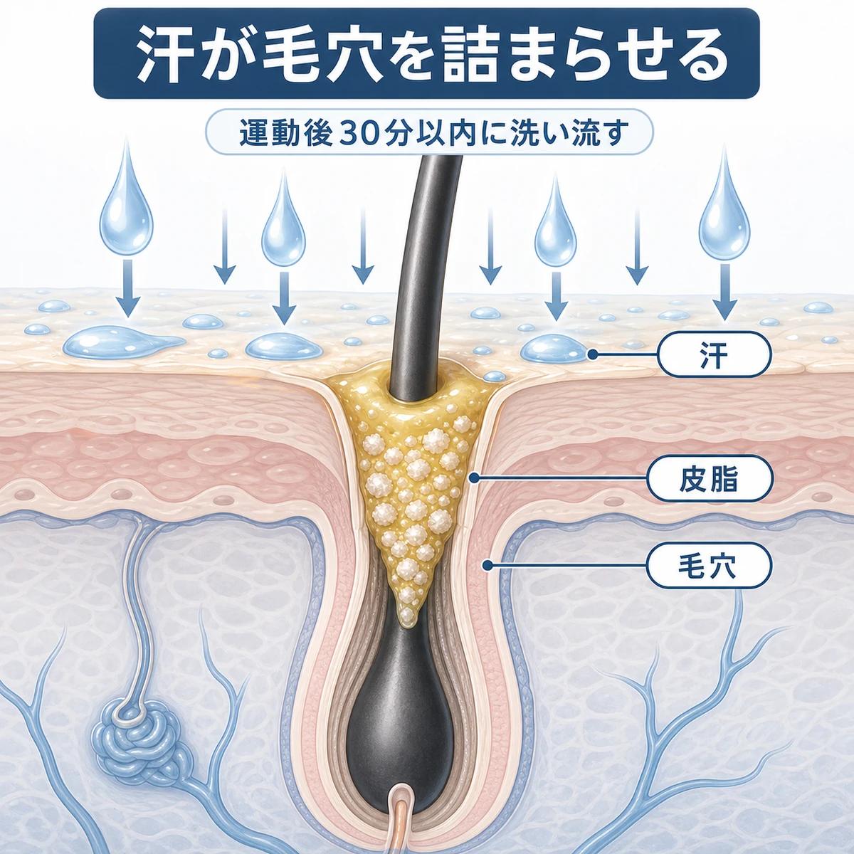 運動後の汗と皮脂が頭皮の毛穴を詰まらせる様子を表した頭皮断面の医療イラスト