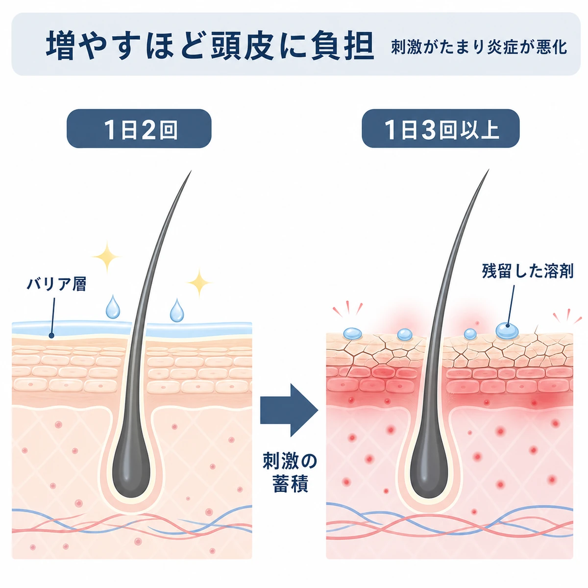 1日2回と3回以上で頭皮の炎症リスクがどう変わるかを比べた頭皮断面の医療イラスト