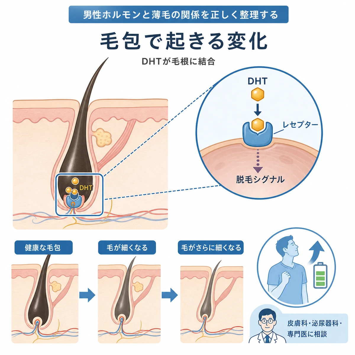 毛包のレセプターにDHTが結合して毛が細くなる仕組みを断面で表した医療イラスト