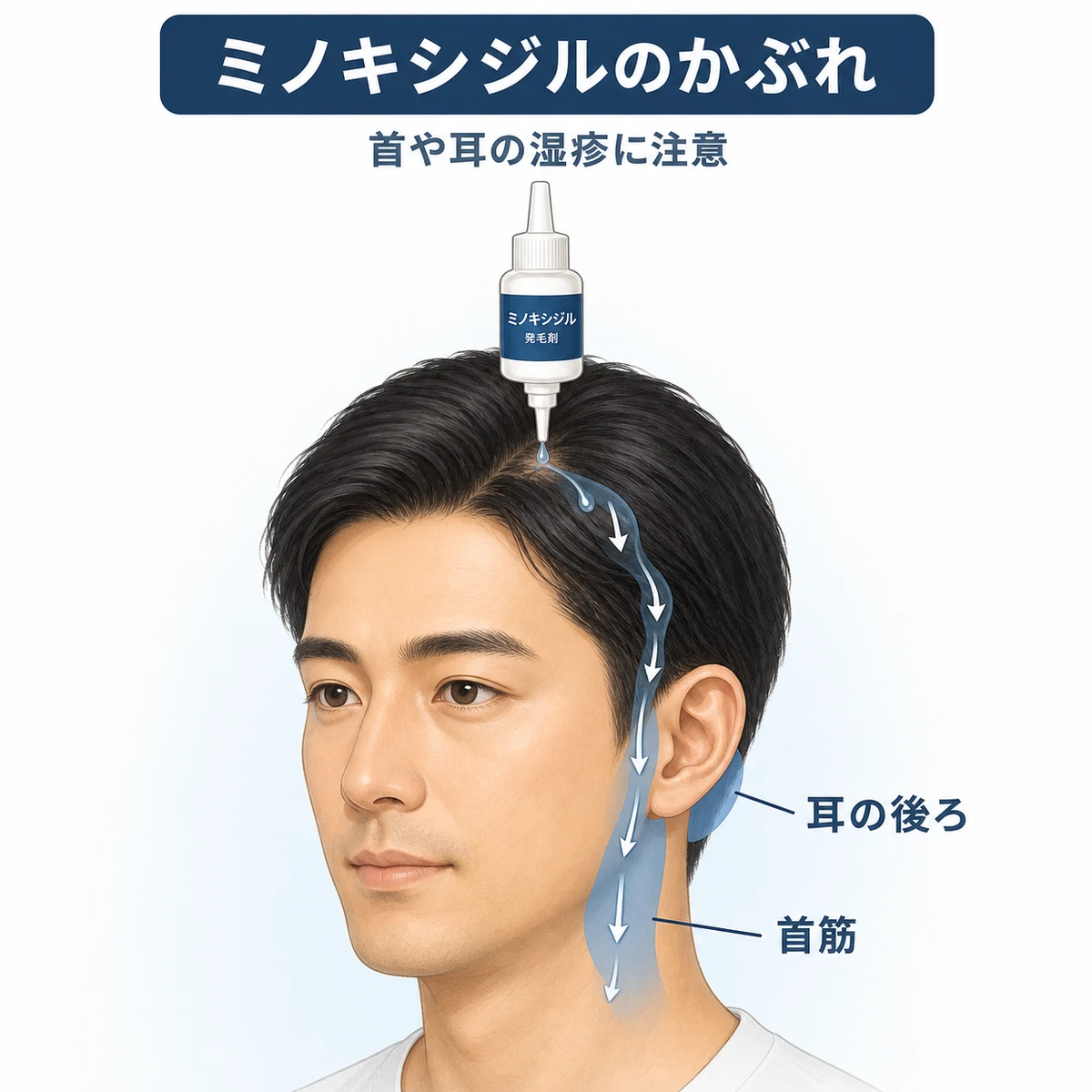 ミノキシジル外用液が首筋や耳の後ろへ流れ落ちて湿疹が広がる分布を表した医療イラスト