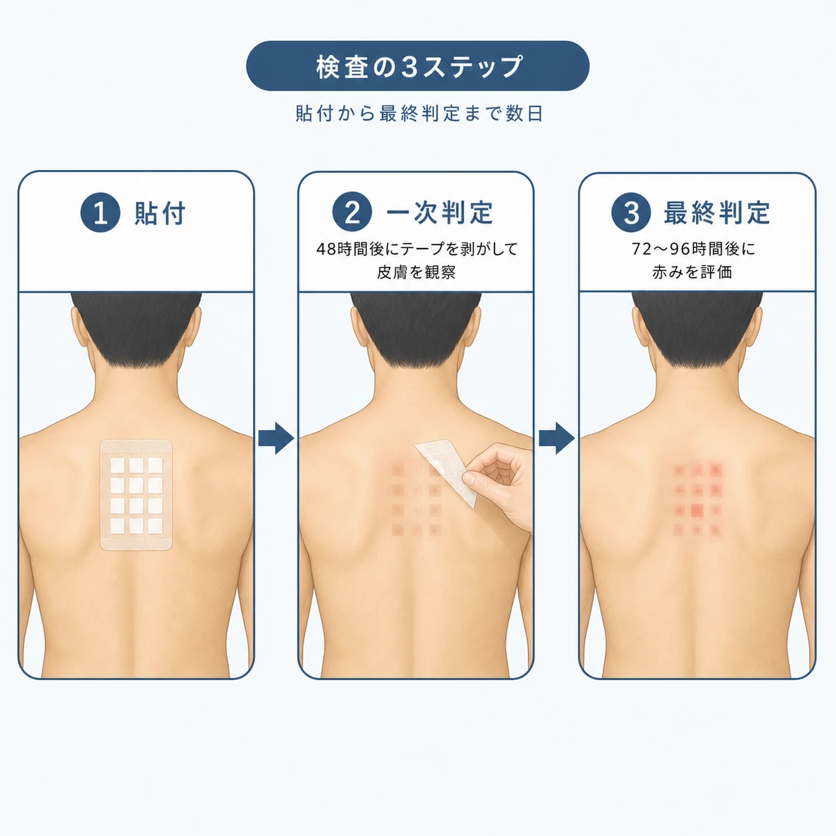 皮膚科のパッチテストが貼付から一次判定・最終判定へ進む3ステップの流れを表した医療イラスト