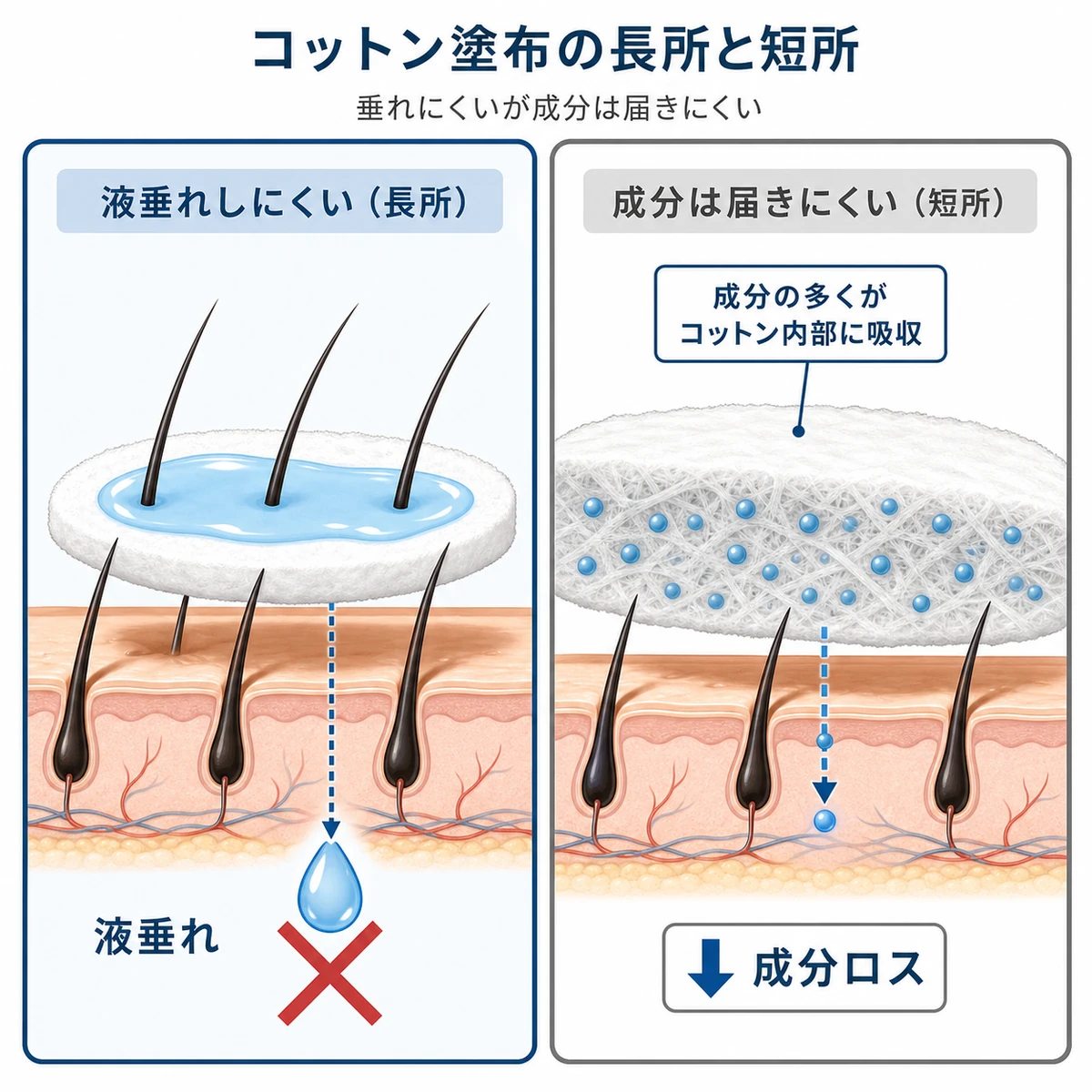 コットンで育毛剤を塗るメリットとデメリットを左右で対比した医療イラスト
