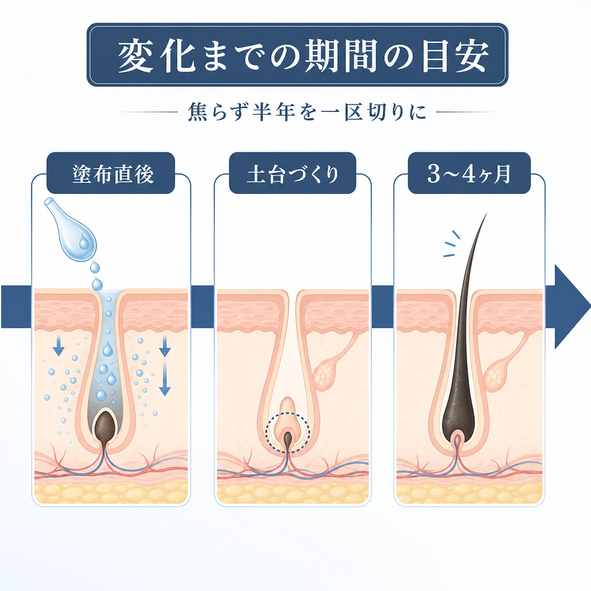 育毛剤の使用開始から変化が見え始めるまでの期間の流れを左から右へ示した医療イラスト