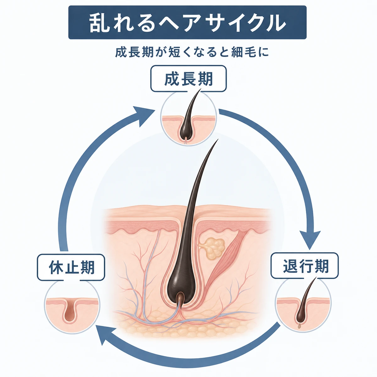 男性の薄毛で成長期が短くなり乱れるヘアサイクルの循環を時計回りに表した医療イラスト