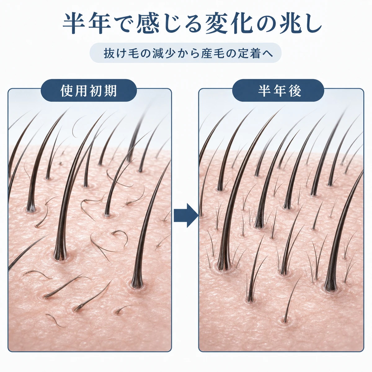 育毛剤を半年続けた頭皮の変化を使用初期と半年後で対比した医療イラスト