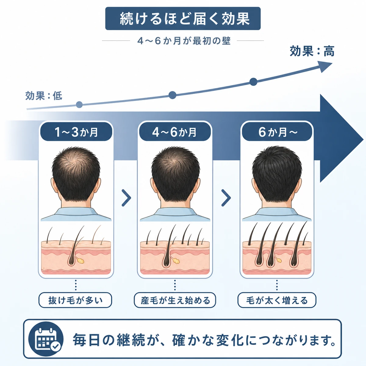 育毛剤を4〜6か月続けるほど効果が高まる経過の流れを表した医療イラスト