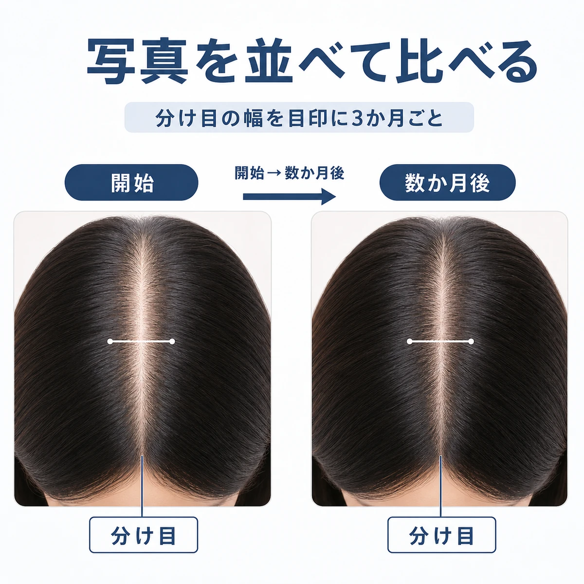 頭頂部の分け目を開始時と数か月後で左右に並べて比較する流れを表した医療イラスト