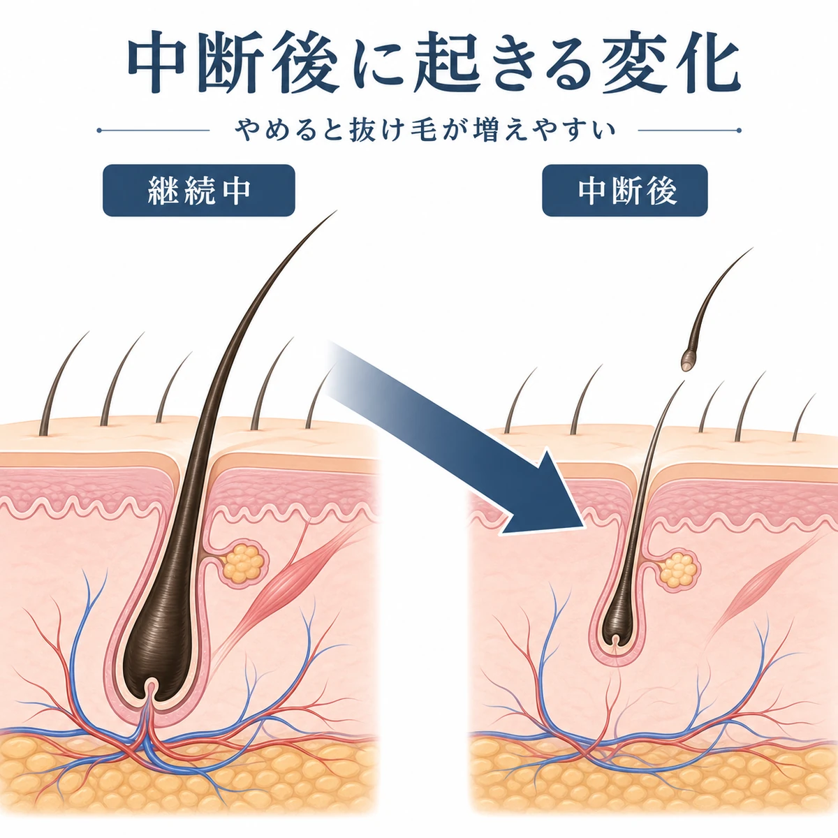 育毛剤を中断すると毛包が弱り抜け毛が増える悪化の流れを表した医療イラスト
