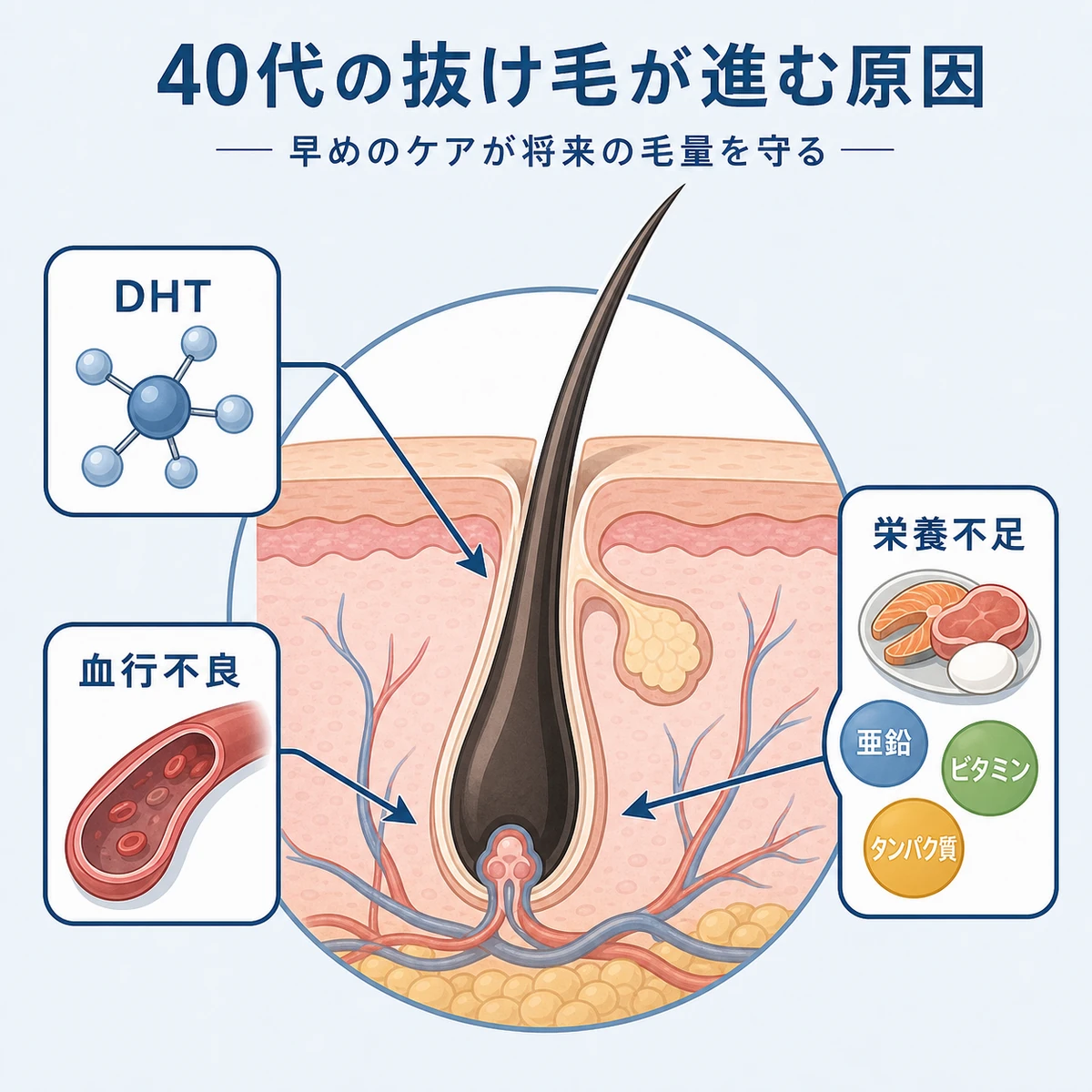 40代の抜け毛が加速する主な原因を毛根の断面図で表した医療イラスト