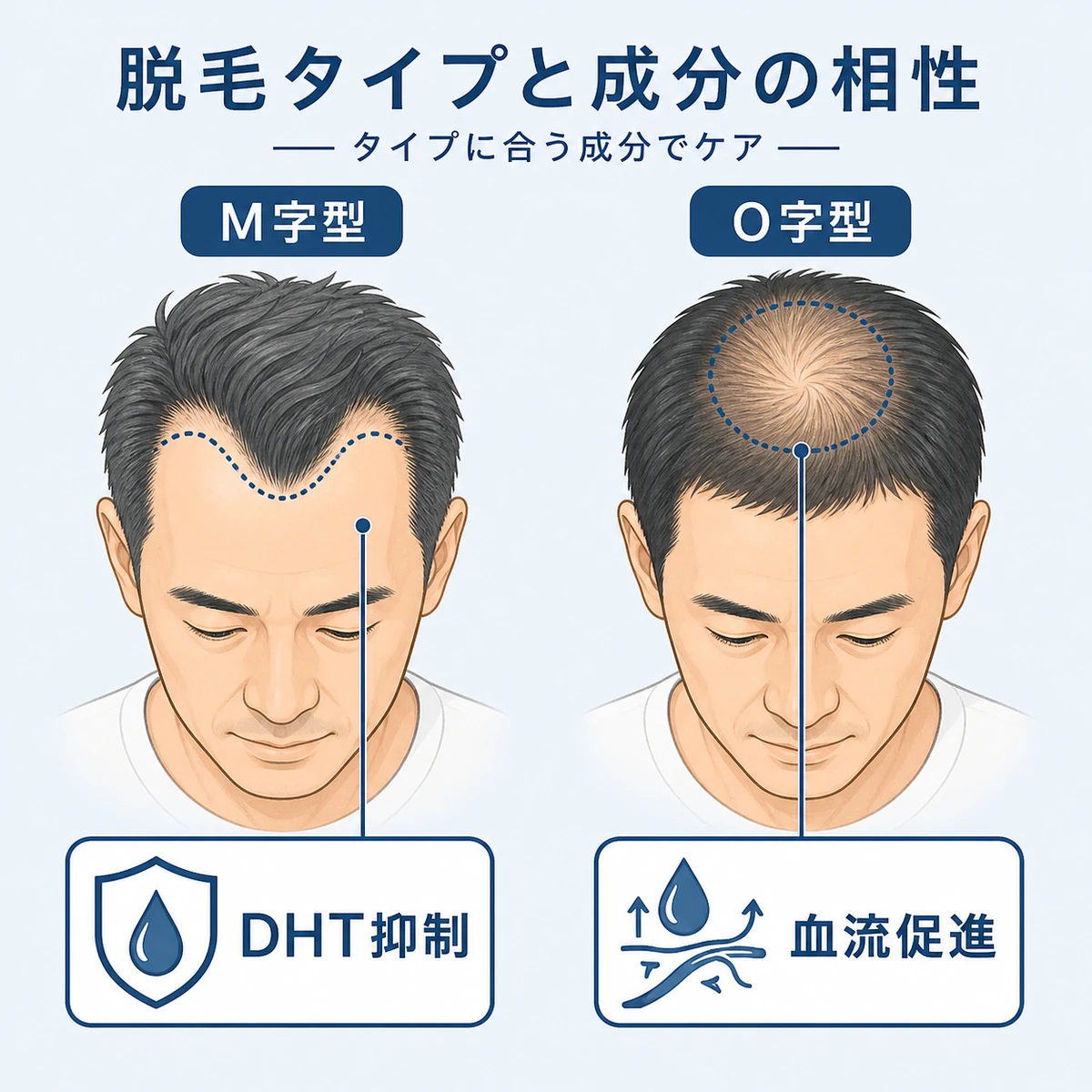 AGAの脱毛タイプごとに相性の良い育毛剤成分を対応づけた医療イラスト