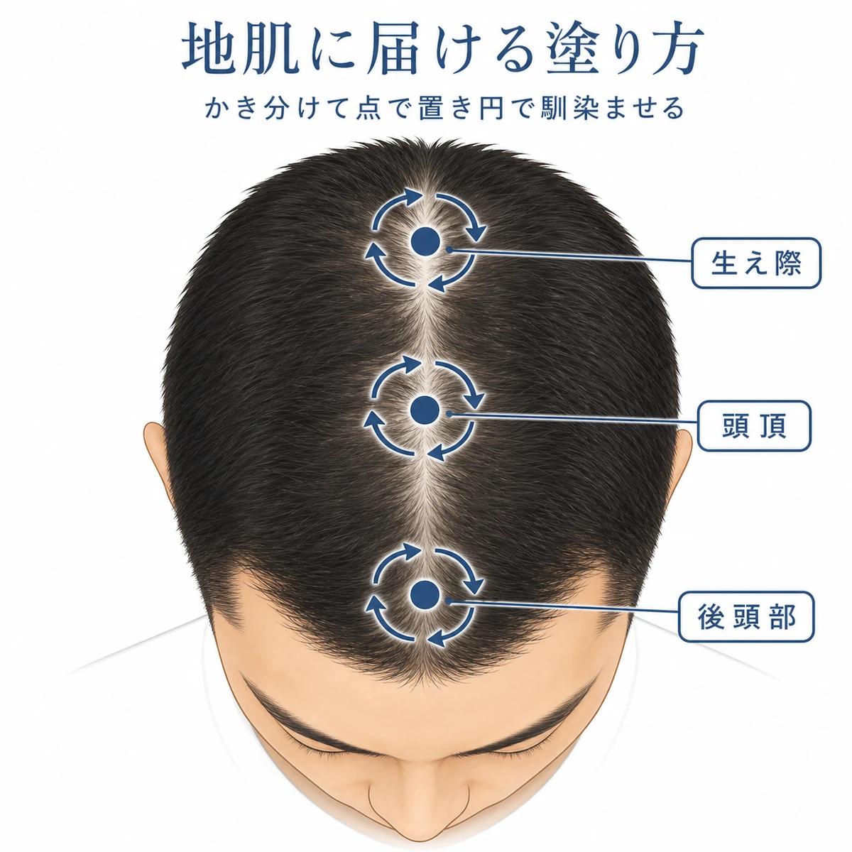 頭部を真上から見て気になる部分に育毛剤を点で塗り馴染ませる塗り方を表した医療イラスト