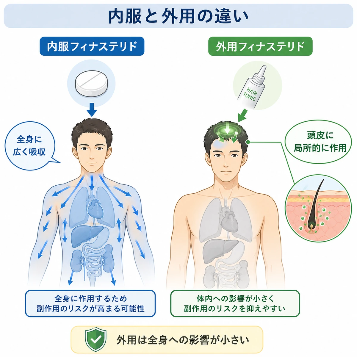 内服フィナステリドと外用フィナステリドの体内への影響範囲の違いを左右で対比した医療イラスト