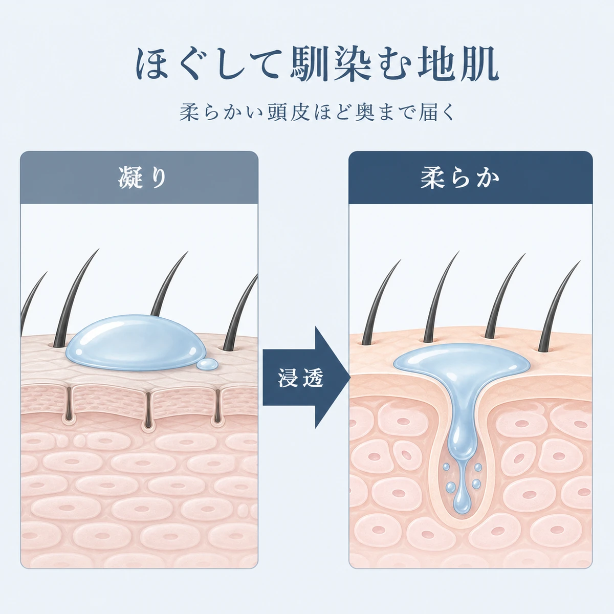 硬い頭皮と柔らかい頭皮で育毛剤の馴染み方が変わる違いを表した医療イラスト
