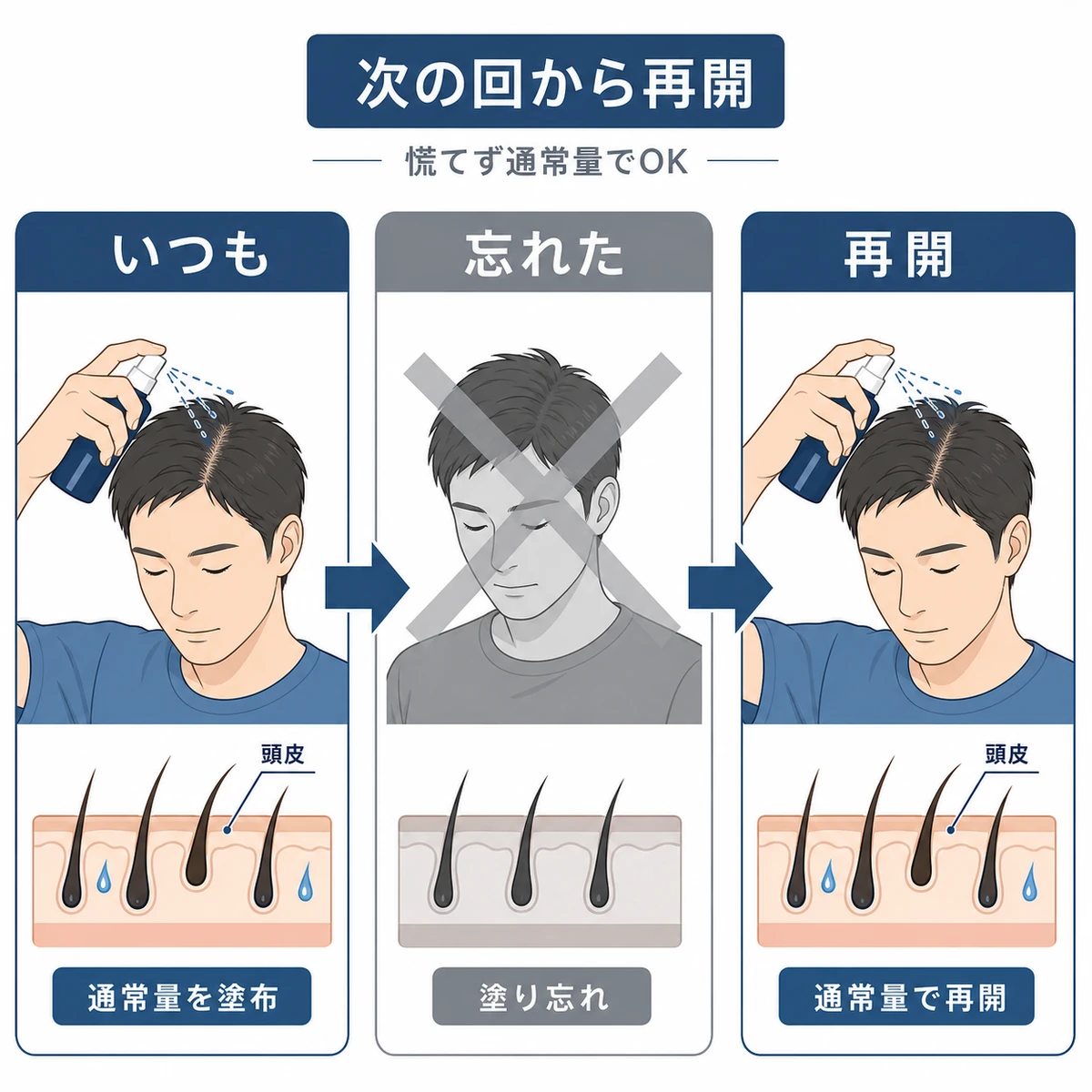 育毛剤を塗り忘れても次の回から通常量で再開する流れを表した医療イラスト