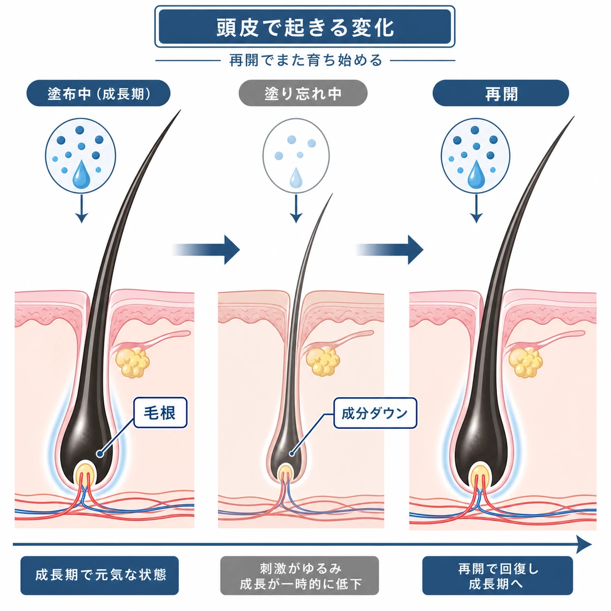 塗り忘れ中の毛根の変化と再開で回復に向かう様子を表した医療イラスト