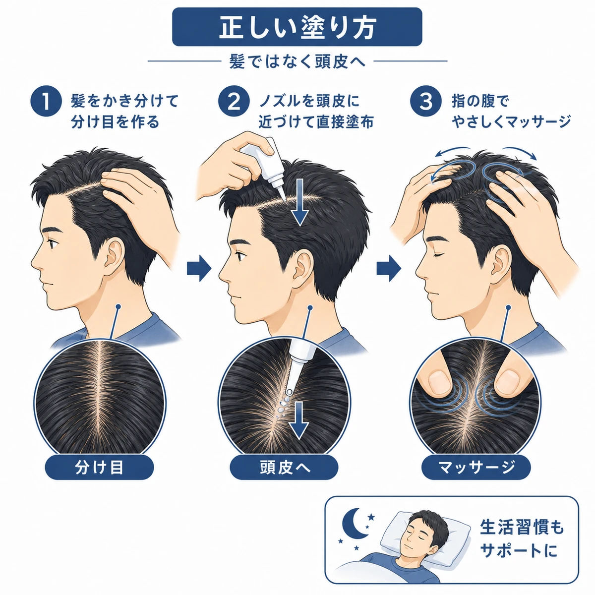 髪をかき分け頭皮に直接育毛剤を塗る正しい手順を表した医療イラスト
