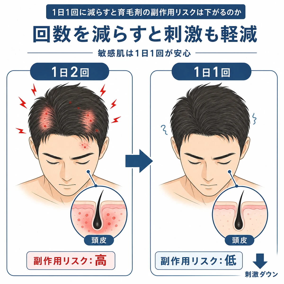 1日2回から1日1回に減らすと頭皮の副作用リスクが下がる様子を対比した医療イラスト