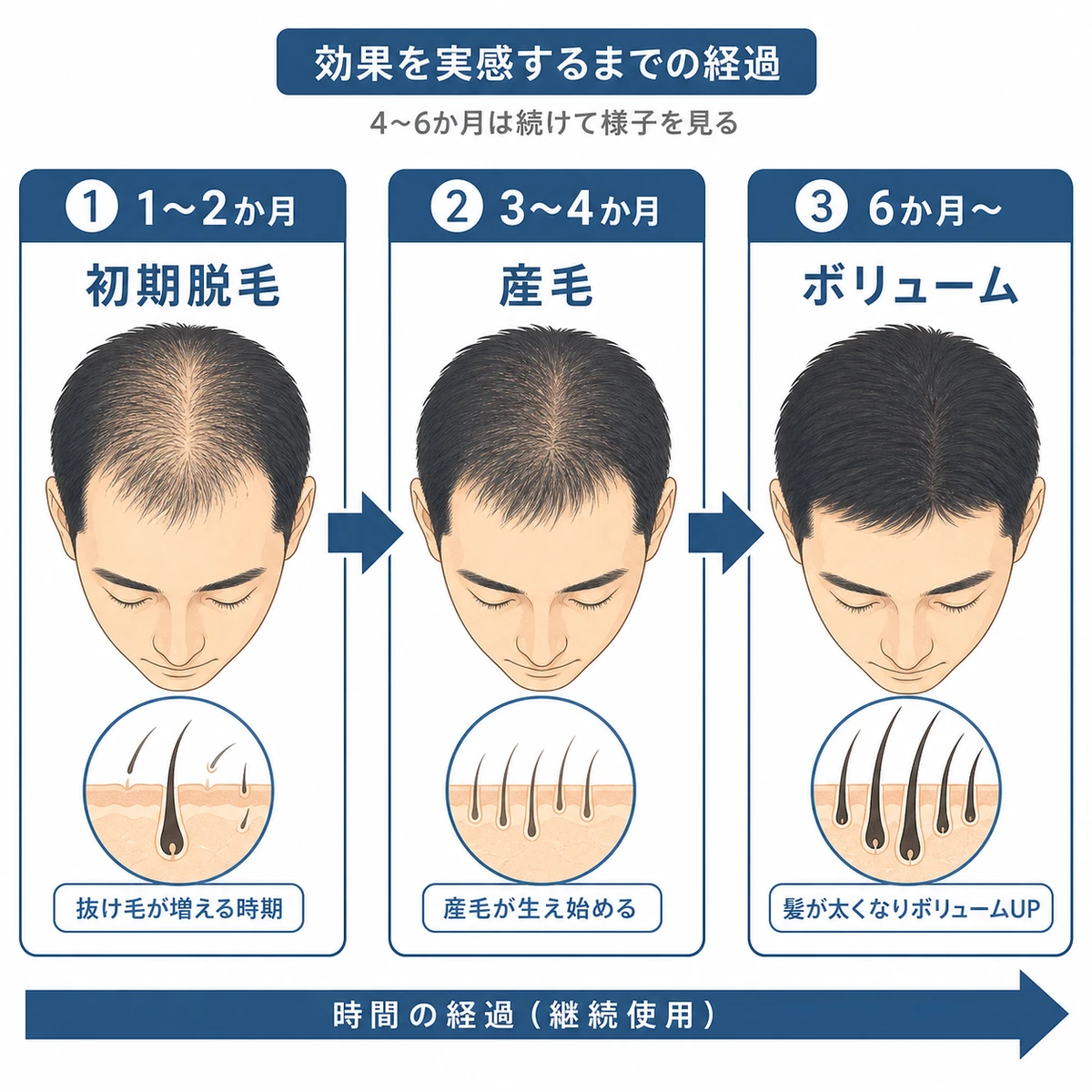 初期脱毛から産毛の発生を経てボリューム改善へ進む経過の目安を左から右へ表した医療イラスト