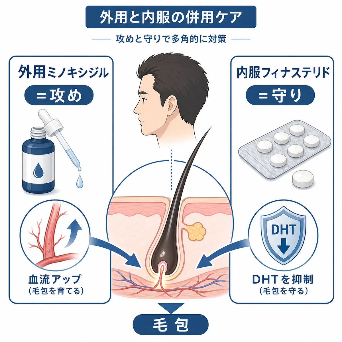 外用ミノキシジルと内服フィナステリドが攻めと守りで毛包に働く併用ケアを表した医療イラスト
