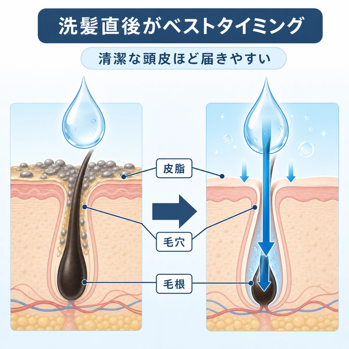 洗髪後の清潔な頭皮に育毛剤が浸透しやすくなる仕組みを毛穴の断面で表した医療イラスト