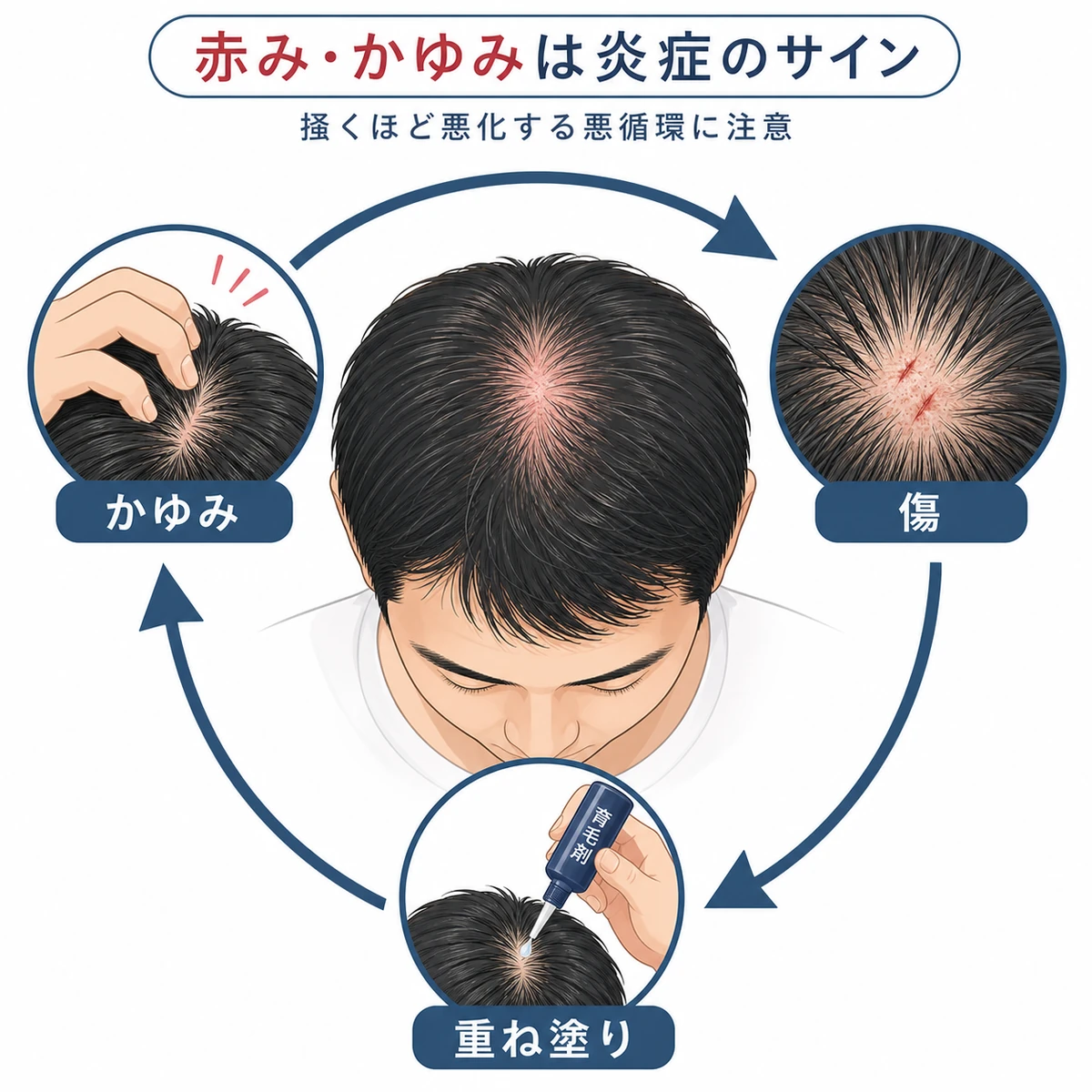 育毛剤の過剰使用で頭皮の赤みやかゆみが悪循環に陥る流れを表した医療イラスト