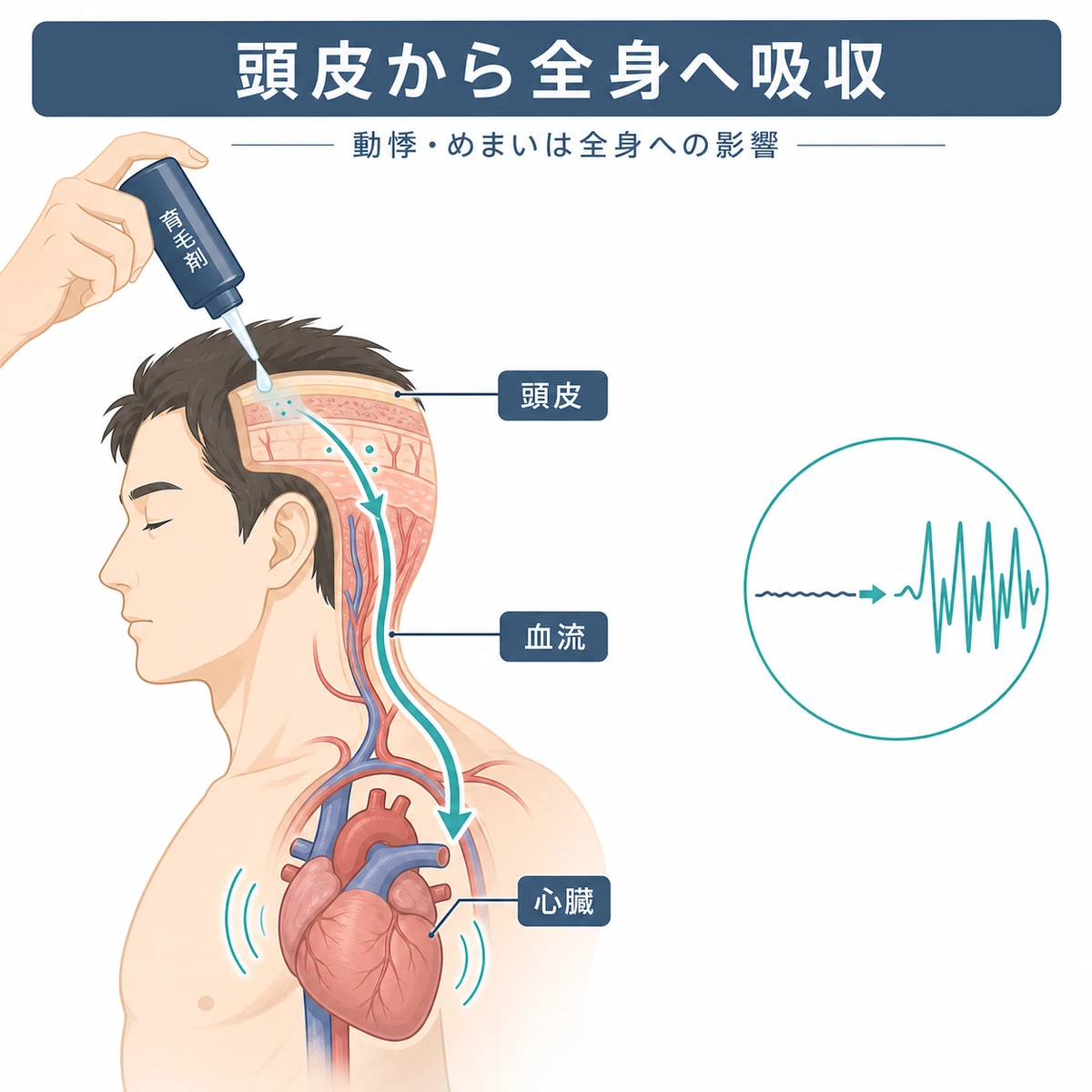 頭皮に塗った育毛剤成分が全身に吸収され心臓に影響する経路を表した医療イラスト