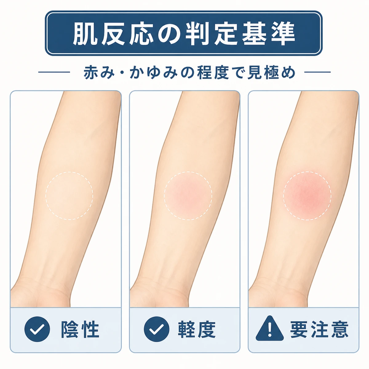 パッチテスト後の肌反応を陰性から要注意まで三段階の腕の状態で見分ける判定基準を表した医療イラスト