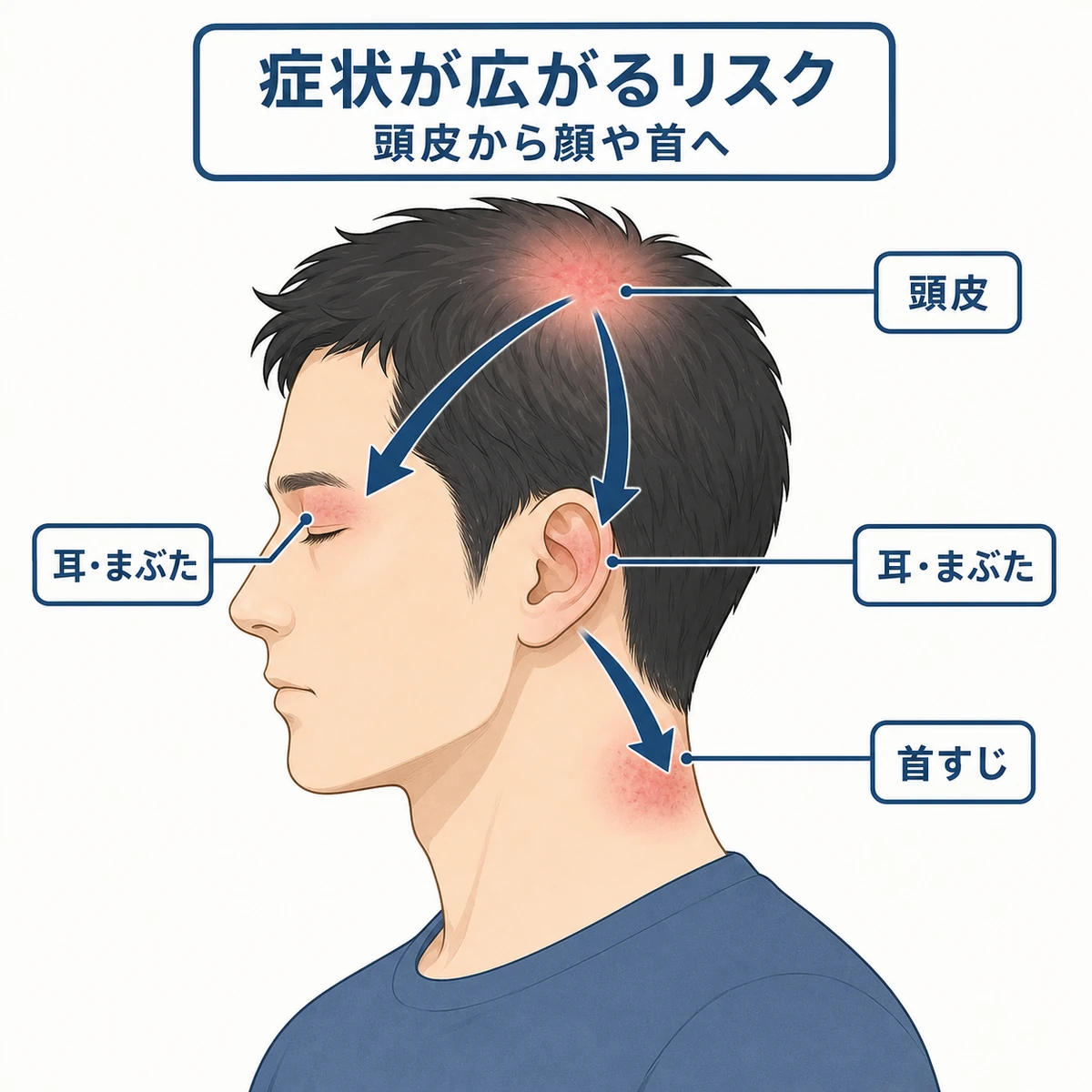 パッチテストをせずに使うと炎症が頭皮から顔や首へ広がる様子を表した医療イラスト