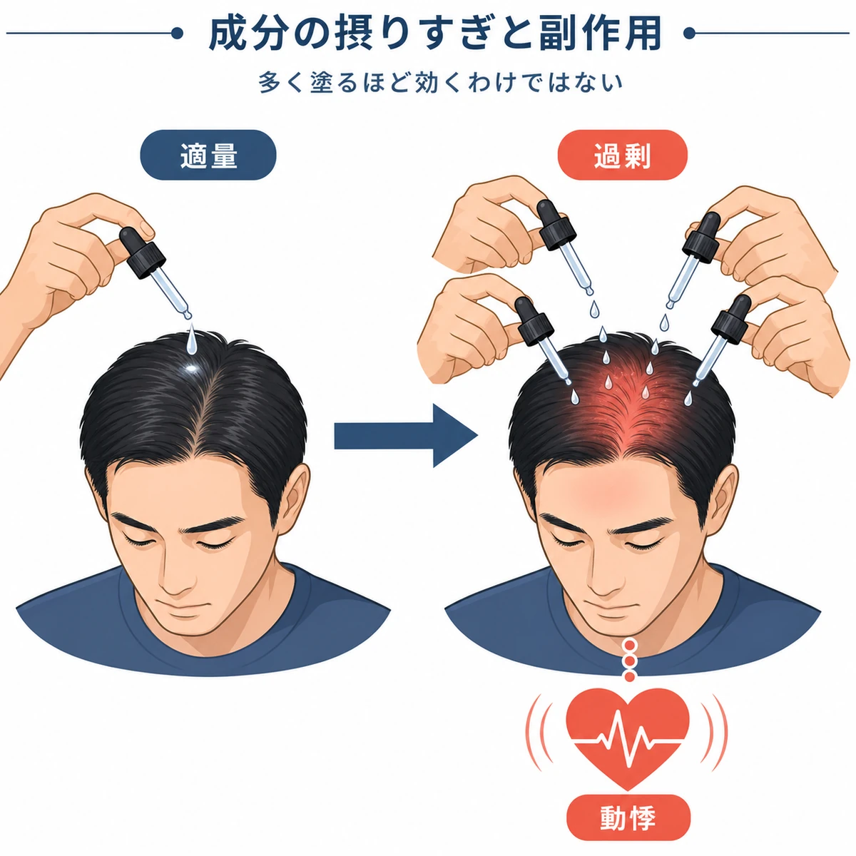 育毛剤の有効成分を適量から過剰へ塗り増やすと副作用が強まる流れを表した医療イラスト