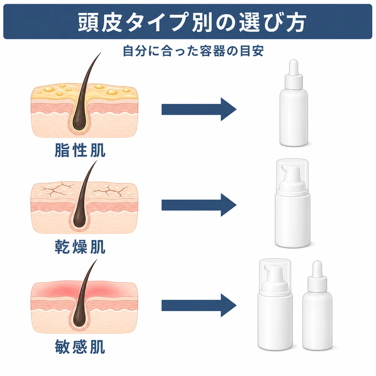 頭皮タイプごとに合う育毛剤容器の対応を左から右へ示した医療イラスト