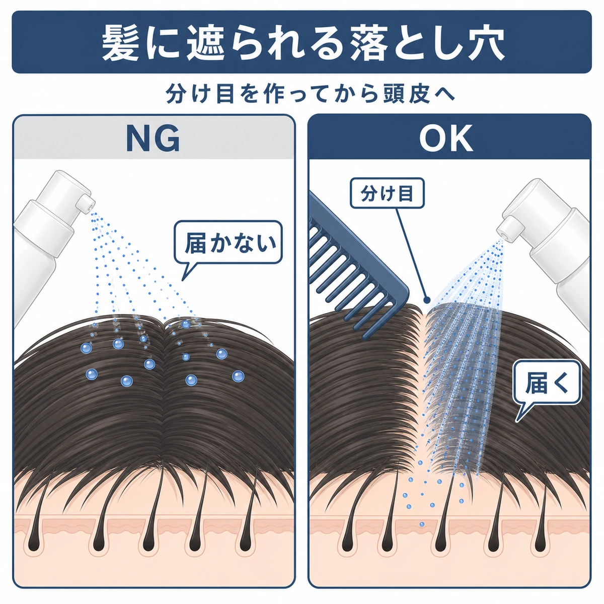 スプレーが髪に遮られる場合と分け目で頭皮に届く場合を対比した医療イラスト