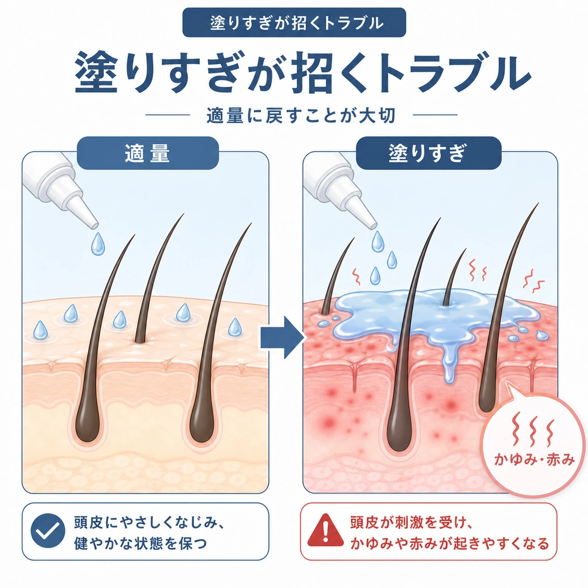 適量と塗りすぎの頭皮を対比し過剰塗布でかゆみや赤みが起きやすくなることを表した医療イラスト