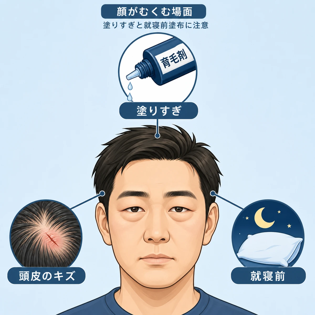 育毛剤の塗りすぎや就寝前塗布で成人男性の顔がむくむ場面を表した医療イラスト