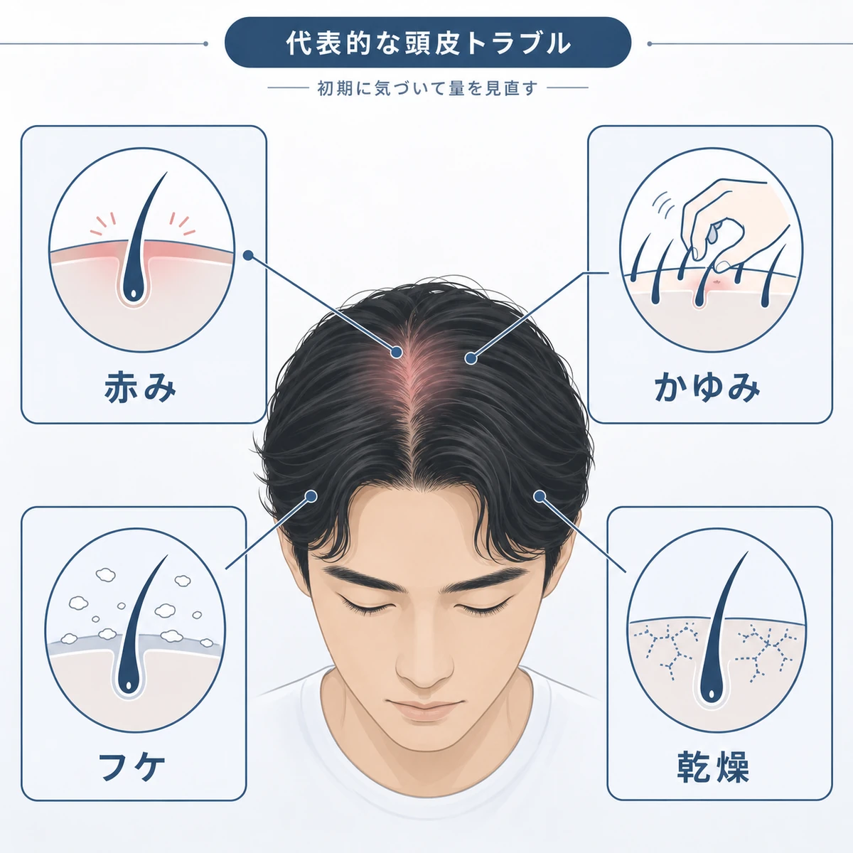 育毛剤の過剰使用で起こる赤みかゆみフケ乾燥の頭皮トラブルを分類した医療イラスト