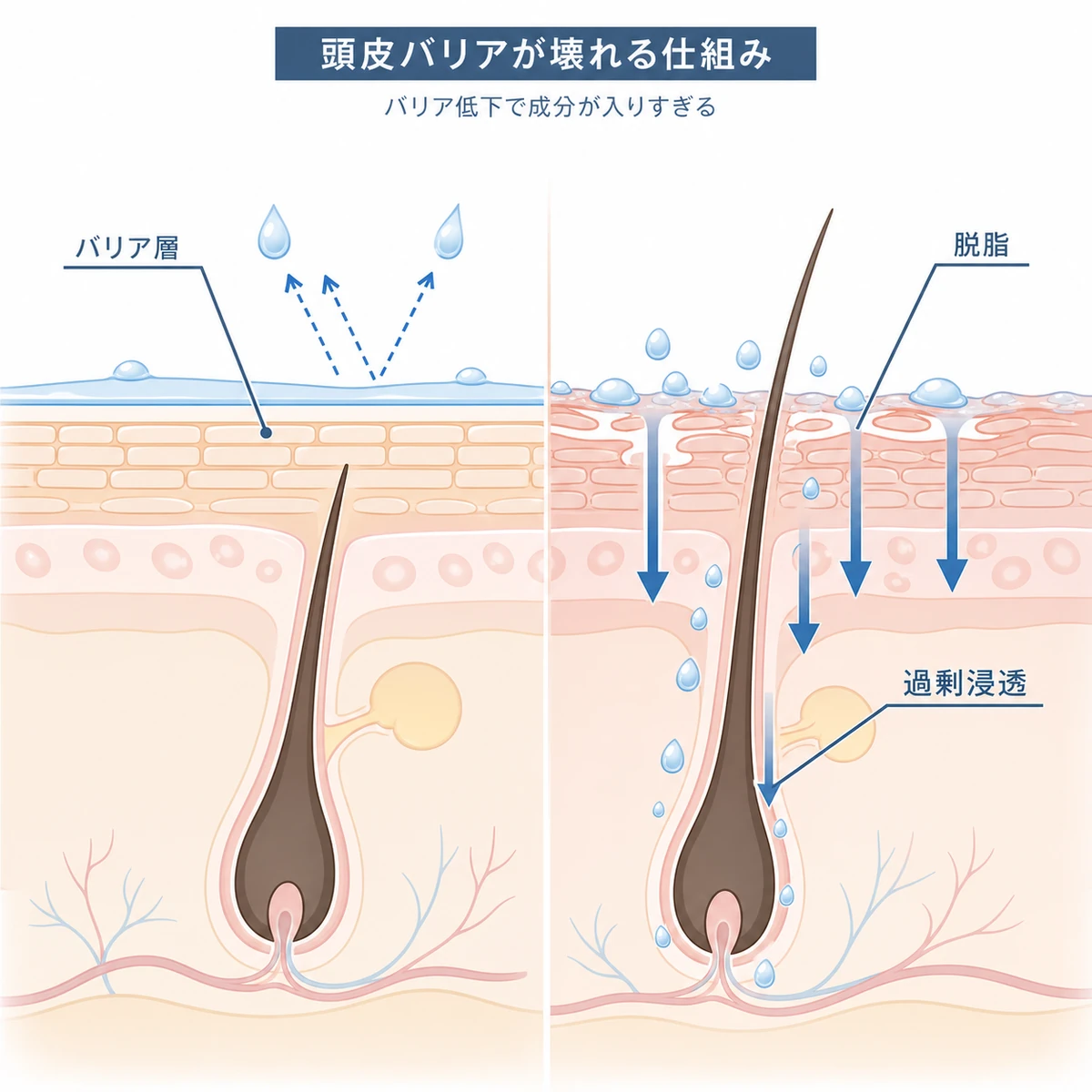 過剰塗布で頭皮バリアが低下し成分が過剰浸透する仕組みを断面で表した医療イラスト