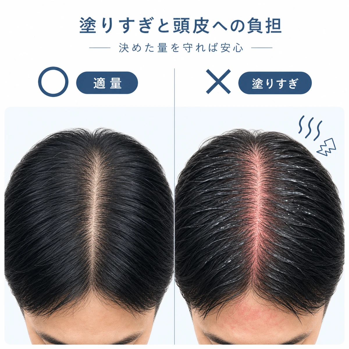 適量と塗りすぎの頭皮を左右で比べた冷静な医療イラスト