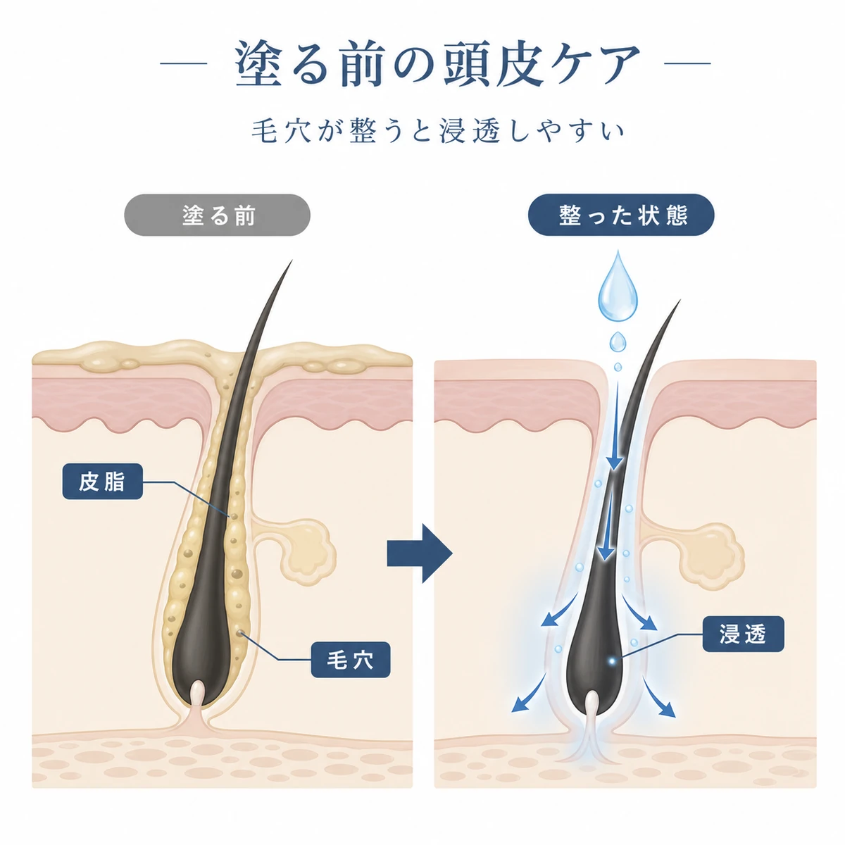 詰まった毛穴と清潔な毛穴の断面を比べた頭皮ケアの医療イラスト