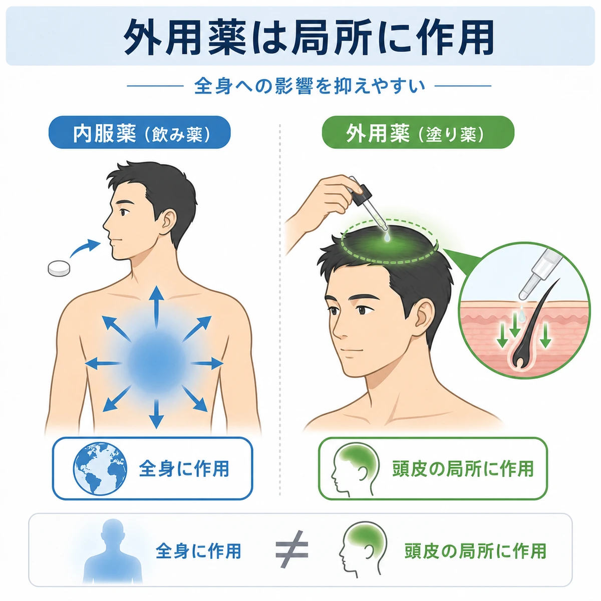 内服薬は全身に外用薬は頭皮の局所に作用する違いを対比した医療イラスト