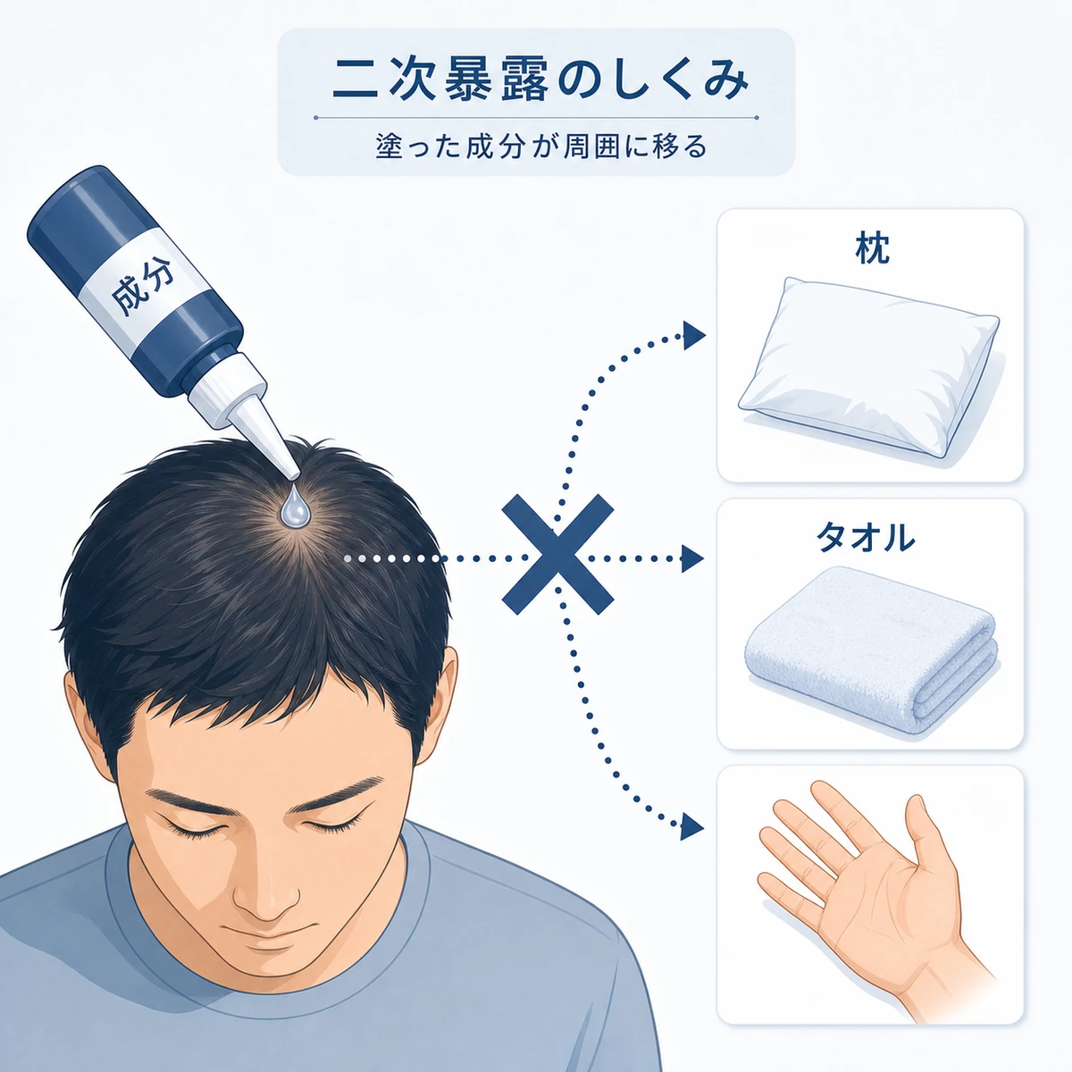 頭皮に塗った育毛剤成分が枕やタオルへ移る二次暴露のしくみを表した医療イラスト