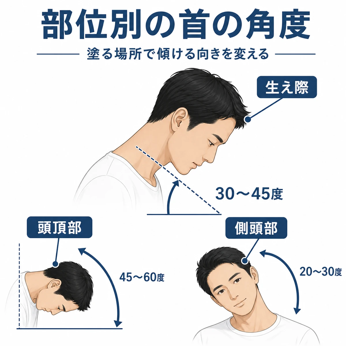塗る部位ごとに首を傾ける角度を示した育毛剤の塗布姿勢イラスト