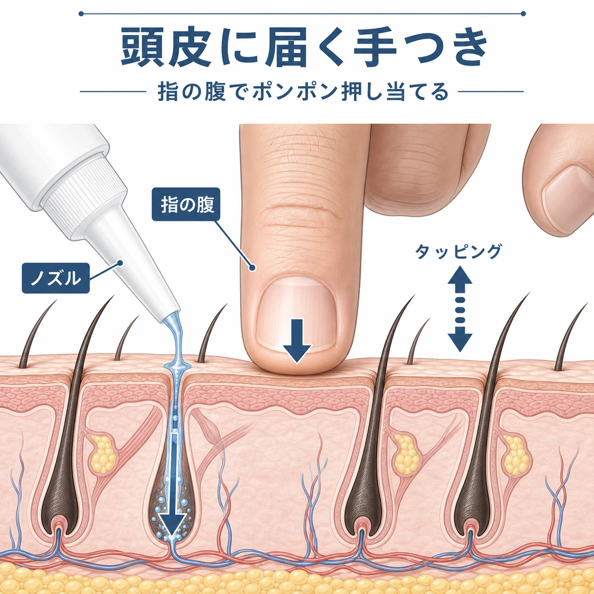 指の腹とノズルで育毛剤を頭皮に届ける手つきを示した医療イラスト