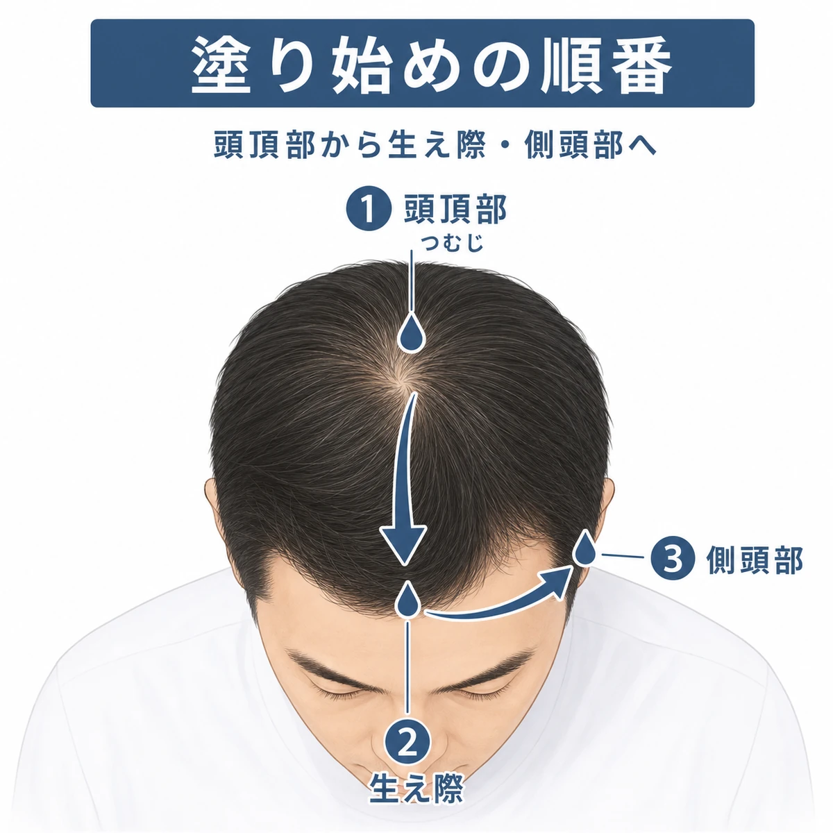 頭頂部から生え際・側頭部へ塗る順番を矢印で示した育毛剤イラスト