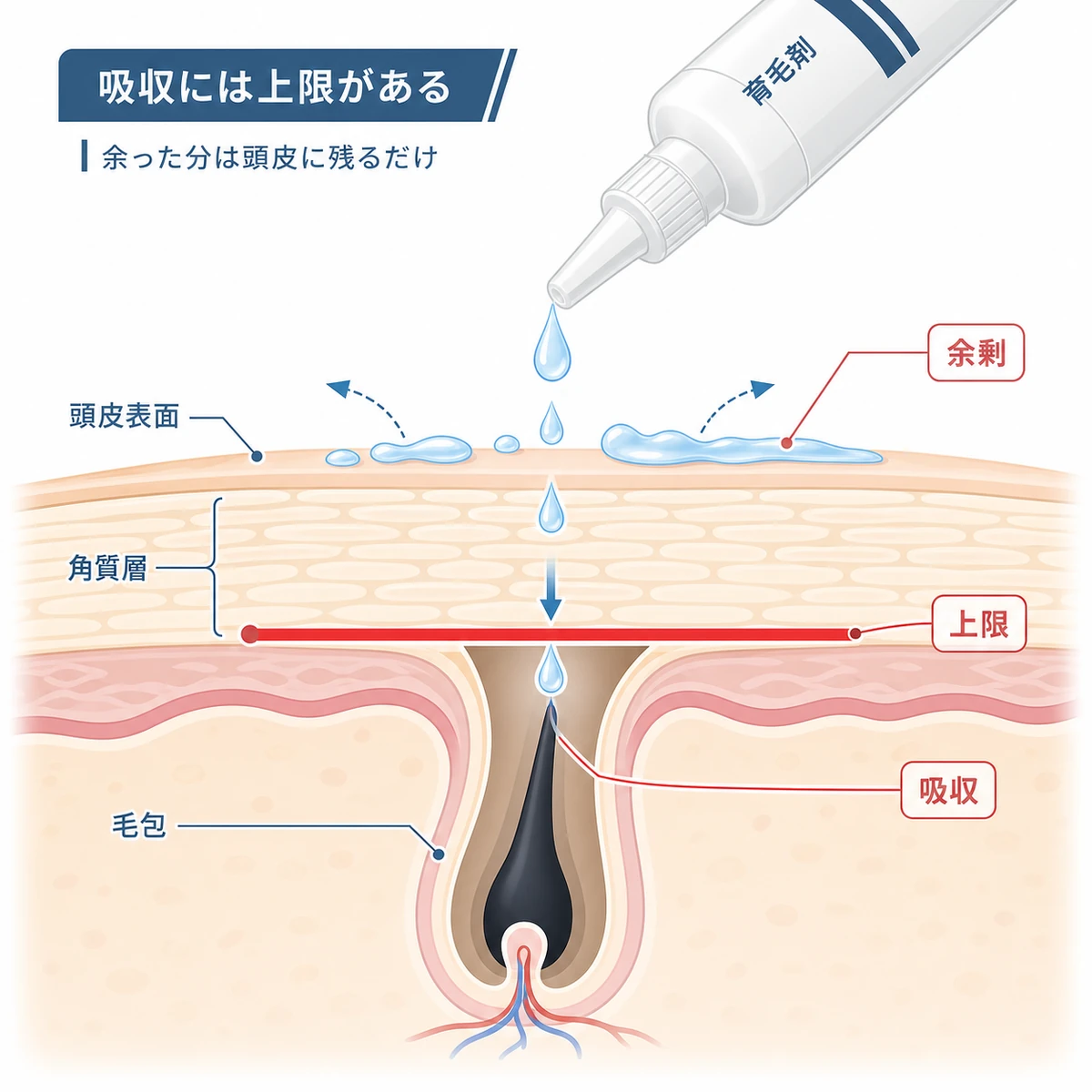 頭皮の断面で育毛剤の吸収に上限があり余剰が表面に残る様子を表した医療イラスト
