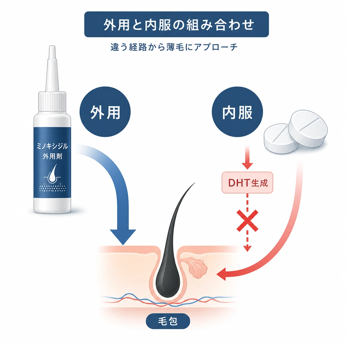 外用薬と内服薬を組み合わせるAGA治療の違う経路を表した医療イラスト