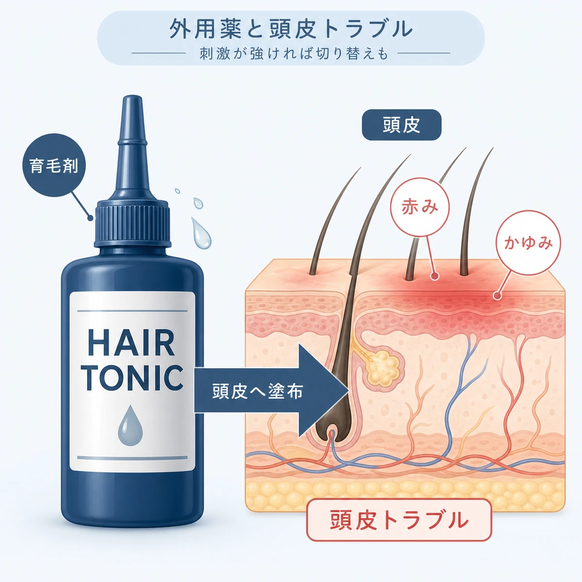 ミノキシジル外用薬の育毛剤容器と頭皮トラブルの関係を表した医療イラスト