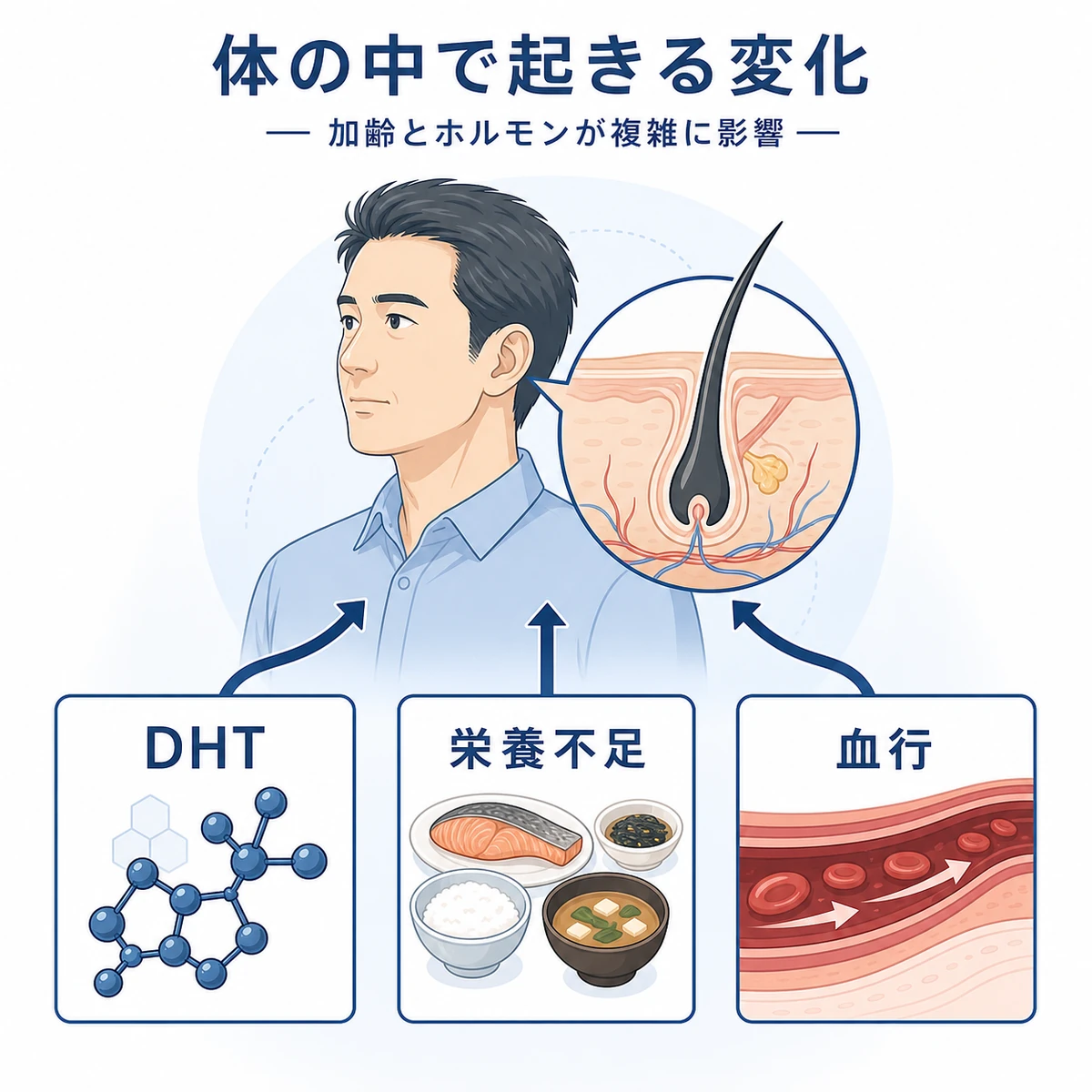 40代男性の薄毛にDHT・栄養不足・血行が複合して影響する仕組みを表した医療イラスト