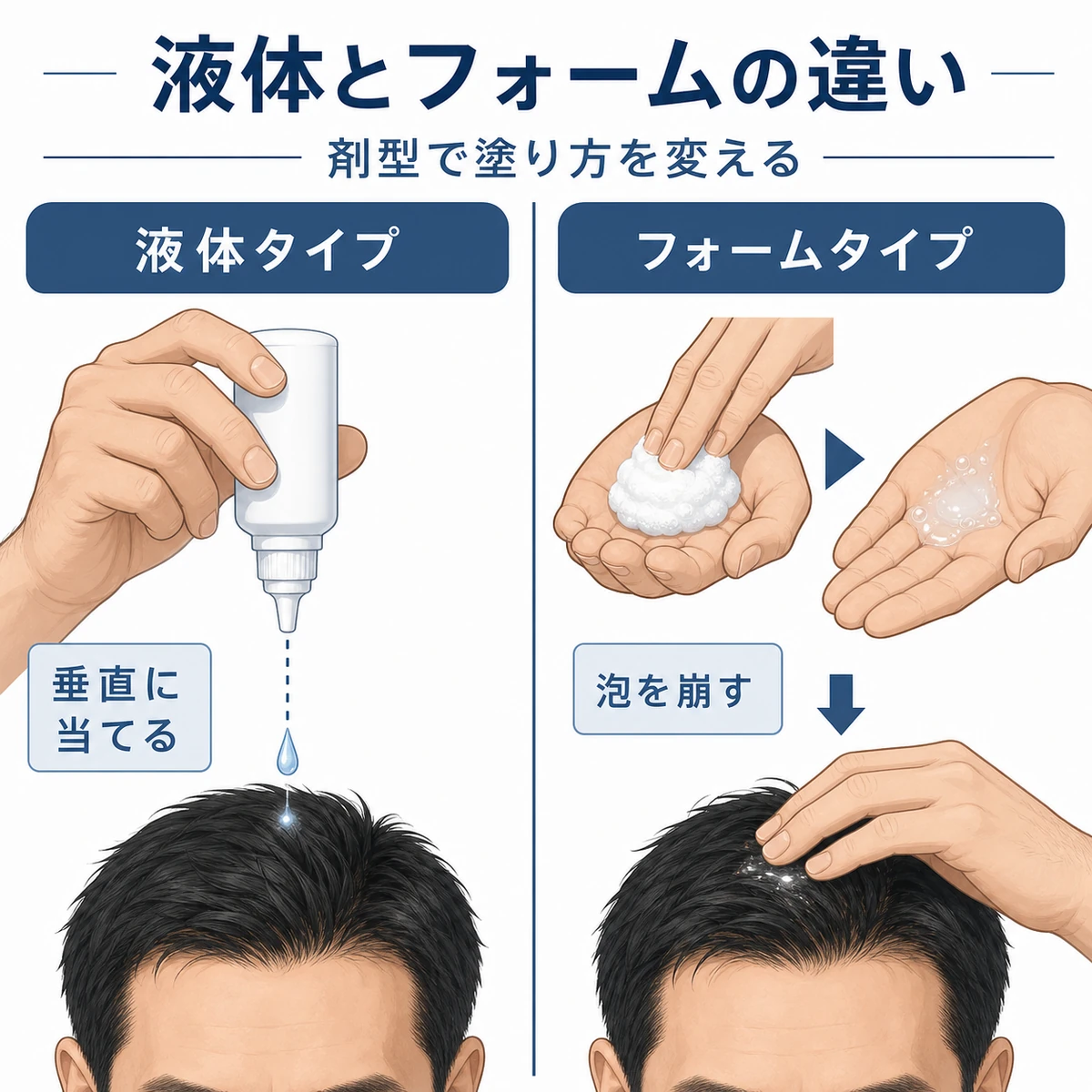 液体タイプとフォームタイプの育毛剤で塗り方の違いを左右で比べた医療イラスト