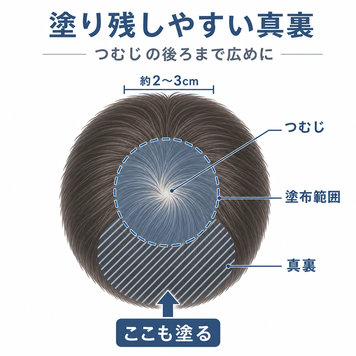 つむじを真上から見た頭頂部で塗り残しやすい後頭部側の範囲を示した医療イラスト